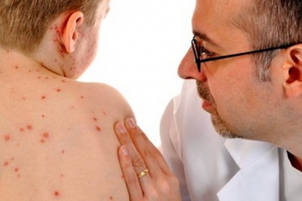 Не вакциновані: на Буковині від початку року на кір захворіли майже три тисячі людей